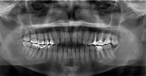 panorâmica dental - fluorosis dental